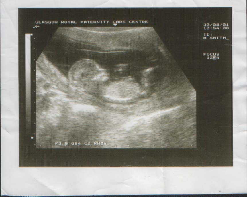 Our new baby, 13 wk scan